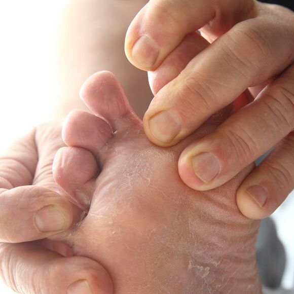 Ο μύκητας επιτίθεται στο δέρμα ανάμεσα στα δάχτυλα των ποδιών