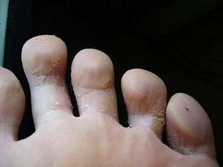 Το ξεφλούδισμα και το ξεφλούδισμα του δέρματος στα πόδια είναι σημάδι μυκητιακής λοίμωξης