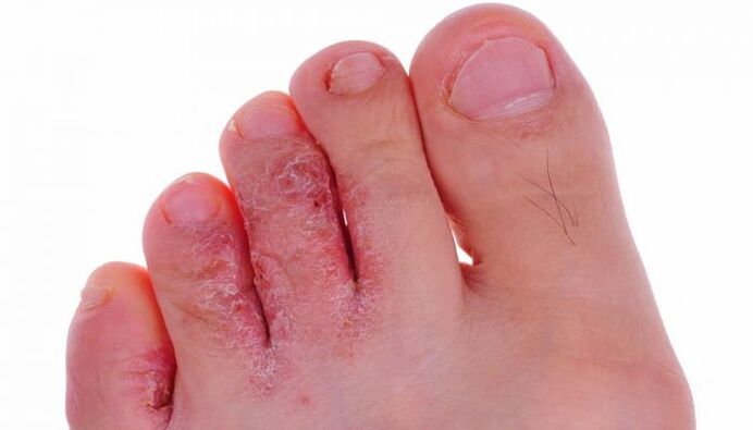 Μυκητιασική λοίμωξη του δέρματος των δακτύλων των ποδιών