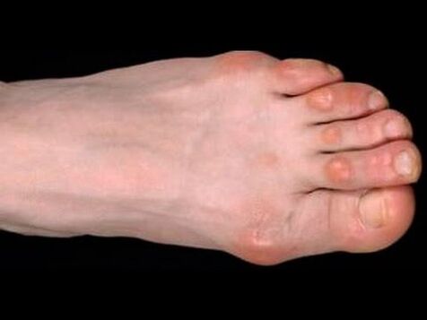 Μύκητας με τα πόδια